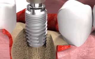 Зубные имплантанты: виды, стоимость и установка
