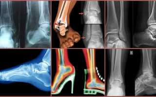 Рентген-исследование голеностопного сустава