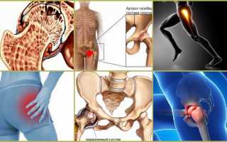 Симптоматика и лечение болезней тазобедренного сустава
