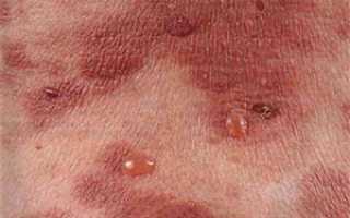 Буллезный дерматит — лечение, причины, симптомы