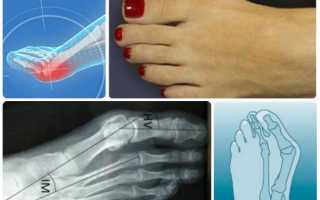 Как лечить шишки на ногах у большого пальца