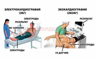 Из-за чего возникает гипертрофия правого предсердия?