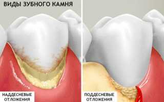 Как очистить зубы от камня: народные и профессиональные методы