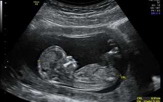 На каком сроке делают первое УЗИ при беременности и что там смотрят