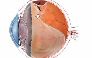 Отслоение сетчатки глаза при беременности