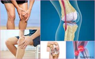 Что такое артроз коленного сустава — чем и как его лечить?