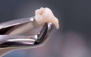 Рекомендации после удаления зуба мудрости: когда можно есть и пить, особенности ухода