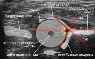 Что показывает УЗИ тазобедренного сустава у детей: когда норма, а когда стоит беспокоится