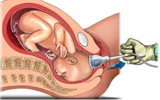 Роды с щипцами или применением вакуум-экстракции: в каких случаях необходимы, плюсы и минусы