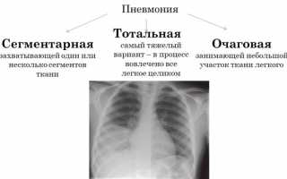 Сегментарная пневмония: этиология, проявления, диагностика, лечение