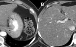 Диагностические возможности КТ печени
