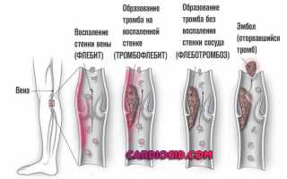 Чем отличается тромбоз от тромбофлебита и флеботромбоза?