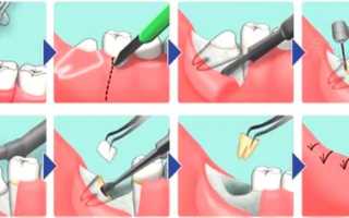 Можно ли удалять зубы во время беременности, как проводится удаление