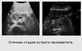 Видно ли панкреатит на УЗИ и что конкретно покажет исследование на мониторе