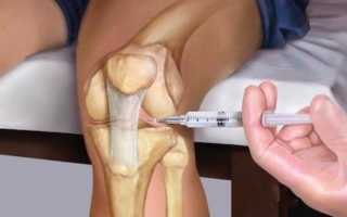 Укол в колено при артрозе коленного сустава — препараты, отзывы