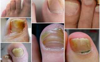 Признаки и лечение начальной стадии грибка ногтей на ногах