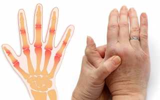 Почему болят суставы пальцев  — что делать, чем и как лечить?