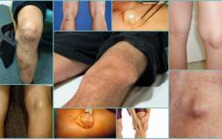 Операции по удалению кисты бейкера коленного сустава (пункция, классическая, артроскопия)