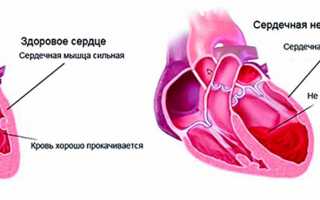 Сердечная недостаточность при беременности — причины, симптомы, риски