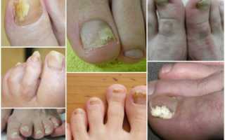 Симптоматика и лечение микоза ногтей на ногах