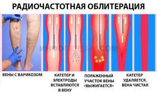 Какие операции проводятся при варикозном расширении вен на ногах?