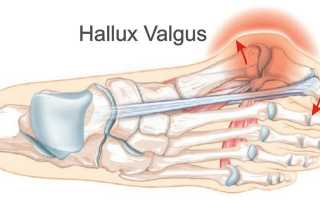 Причины, симптомы и лечение вальгусной деформации большого пальца стопы