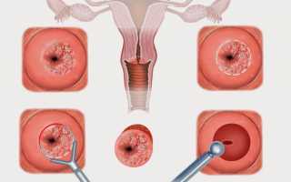 Эрозия шейки матки при беременности