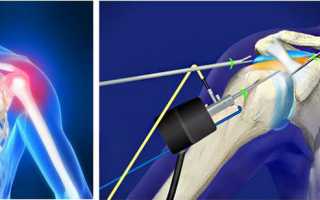 Суть и методика артроскопии плечевого сустава: ход операции, анестезия и реабилитация