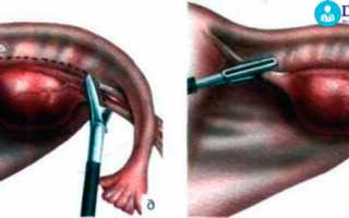 Проведение лапароскопии яичников — суть и виды процедуры, подготовка и возможные последствия операции
