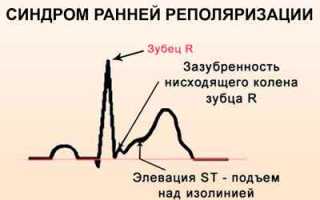 Все о синдроме ранней реполяризации желудочков