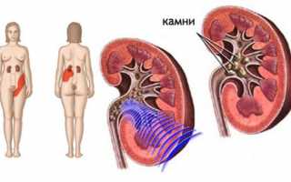 Лечение мочекаменной болезни при беременности