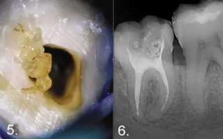 Пульпит зуба: что это, причины и методы лечения