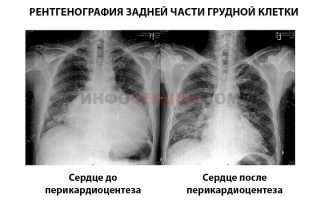 Что такое тампонада сердца и в чем отличие от гемотампонады?