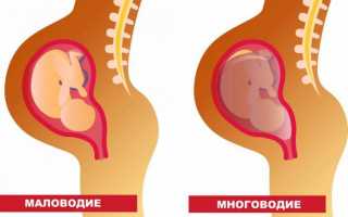 Маловодие при беременности
