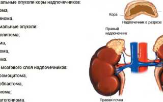 Рак надпочечников: причины, симптомы, диагностика и лечение