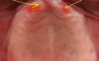 Лечение стоматита во рту у взрослых в домашних условиях