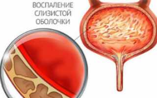 Как проводится инстилляция уретры у мужчин и женщин