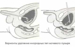 Операция по удалению камней из мочевого пузыря (цистолитотомия)