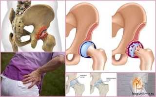 Симптомы и лечение коксартроза (артроза тазобедренного сустава) 3 степени