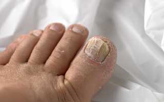 Эффективное средство от грибка ногтей на ногах — список препаратов