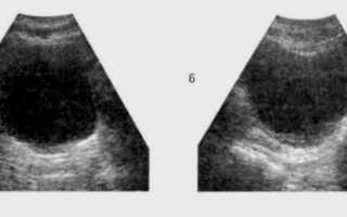 Что показывает УЗИ мочевого пузыря: подготовка, проведение, стоимость