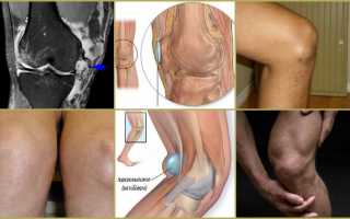 Симптоматика и лечение бурсита гусиной лапки коленного сустава
