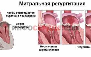 Что такое митральная регургитация?