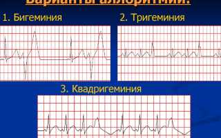 Что такое бигеминия, тригемения и квадригеминия?