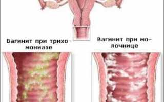 Передается ли цистит партнеру половым путем?