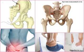 Артроз крестцово-подвздошных сочленений — что это такое, как лечить патологию?