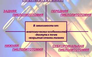 Осложнения и период восстановления после пиелолитотомии