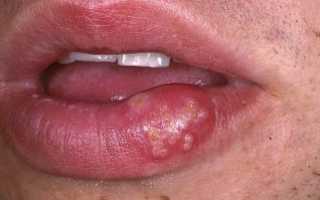 Болячки на губах с внутренней стороны и снаружи: виды, причины, чем и как лечить
