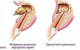 Резекция верхушки корня зуба: суть и этапы операции, восстановление после операции