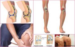 Что такое гонартроз коленного сустава — чем и как его лечить?